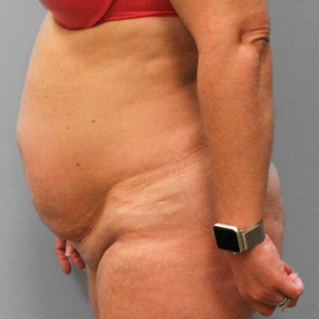 Before image 3 Case #107801 - Tummy Tuck