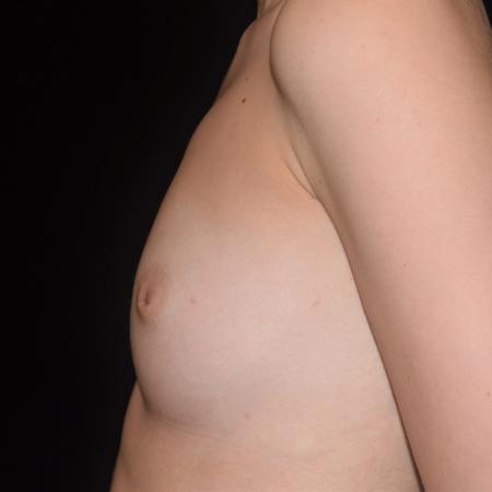 Before image 5 Case #107901 - Underarm Endoscopic Breast Augmentation