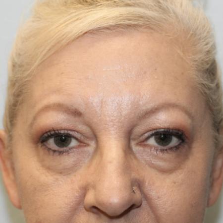 Before image 1 Case #108211 - Blepharoplasty
