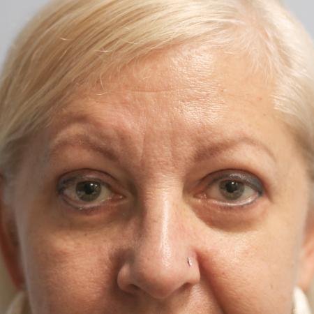 After image 1 Case #108211 - Blepharoplasty