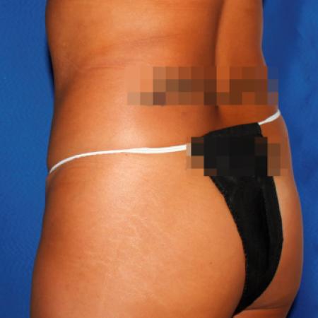 Before image 4 Case #107826 - Liposuction Abdomen/Flanks with Abdominal Etching