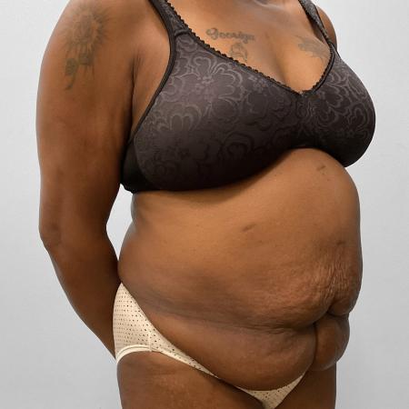 Before image 2 Case #107551 - Tummy Tuck 