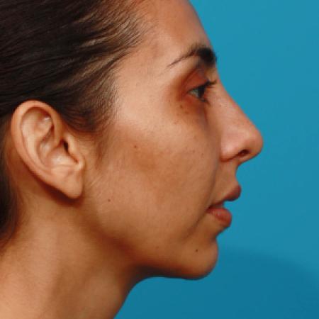 After image 3 Case #108301 - Chin Augmentation