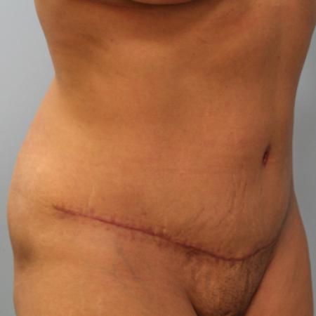 After image 2 Case #108106 - Tummy Tuck