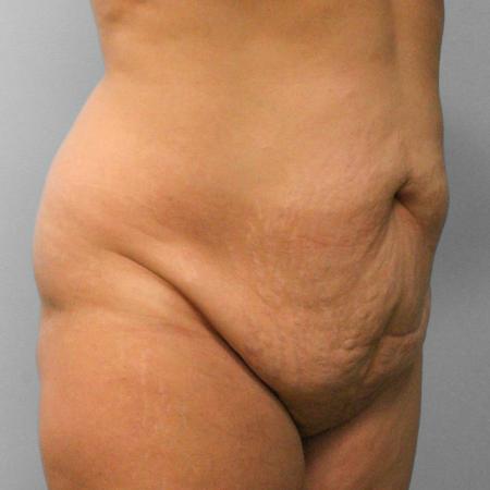 Before image 2 Case #108106 - Tummy Tuck