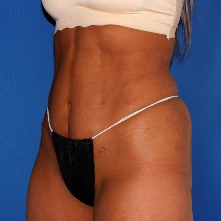 After image 2 Case #107826 - Liposuction Abdomen/Flanks with Abdominal Etching