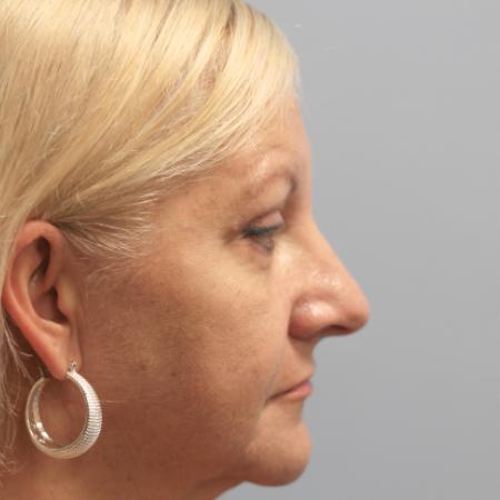 After image 3 Case #108211 - Blepharoplasty