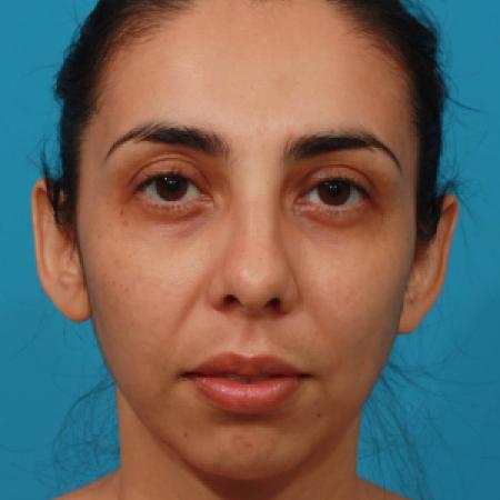Before image 1 Case #108301 - Chin Augmentation