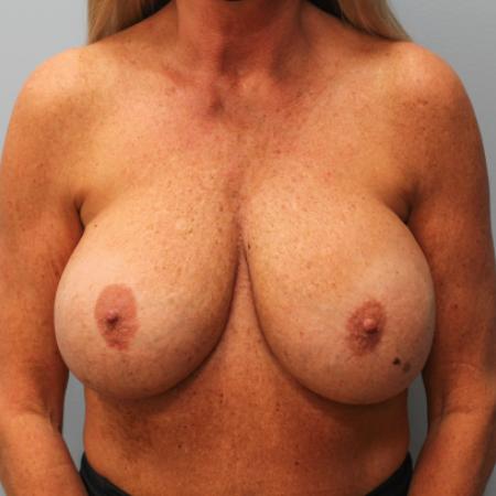 Before image 1 Case #108081 - Breast Revision