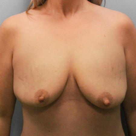 Before image 1 Case #108116 - Breast Augmentation with Lift