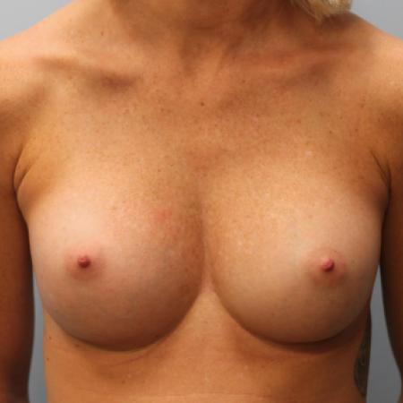 After image 1 Case #107951 - Breast Augmentation
