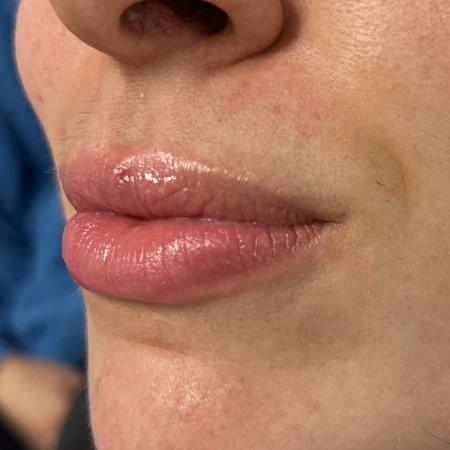 Before image 2 Case #108016 - Lip Filler