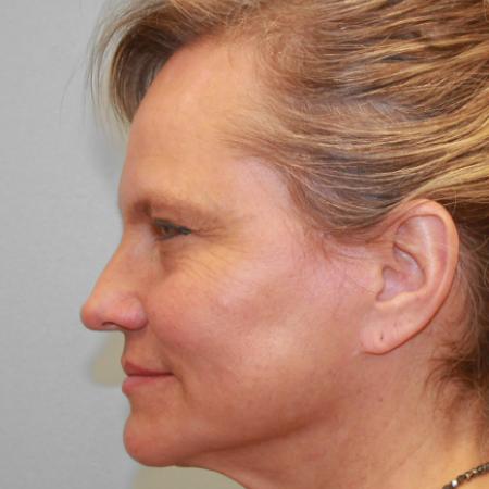 Before image 3 Case #107731 - Facelift