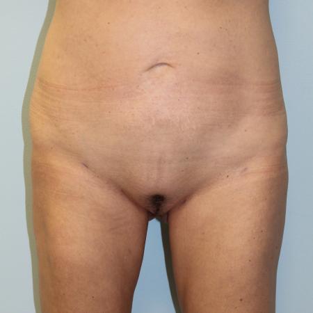 After image 1 Case #108216 - Liposuction