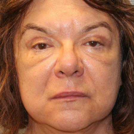 After image 1 Case #107686 - Facelift