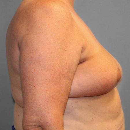 After image 3 Case #107816 - Breast Reconstruction