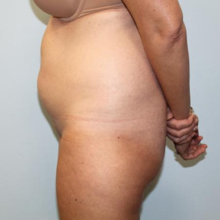 Before image 3 Case #108216 - Liposuction