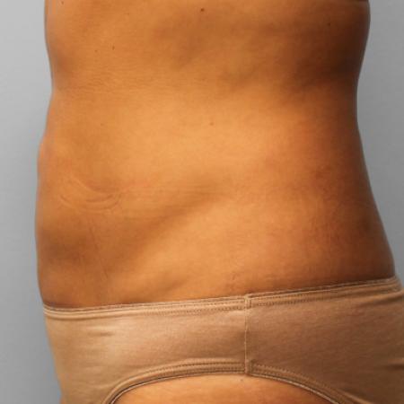 After image 3 Case #107711 - SmartLipo