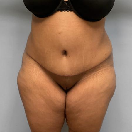 After image 1 Case #108136 - Tummy Tuck & BBL