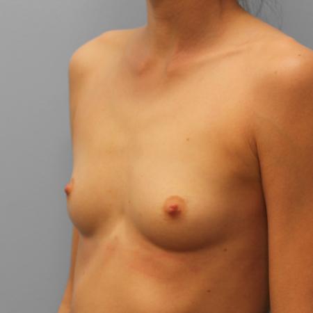 Before image 2 Case #108261 - Breast Augmentation