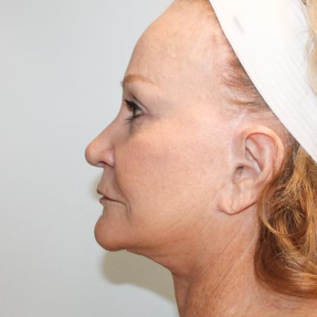 After image 3 Case #107611 - Facelift