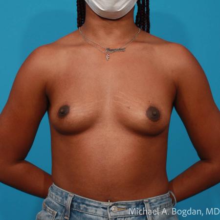 Before image 1 Case #108351 - Breast Augmentation