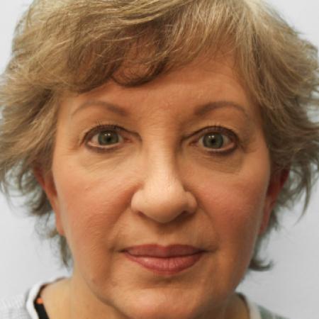 Before image 1 Case #107561 - Blepharoplasty