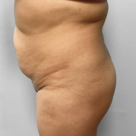 Before Case #108131 - Lipo & BBL