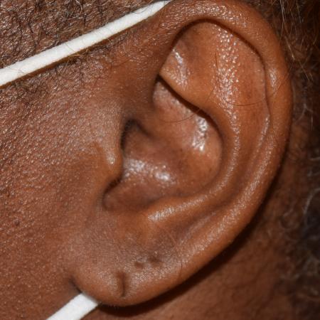 Before image 2 Case #107911 - Bilateral Earlobe Repair & Ear Piercing