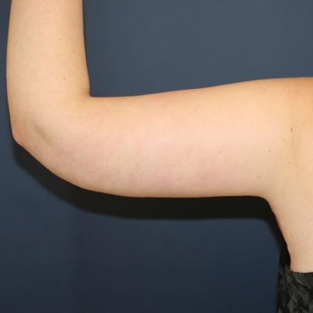 After image 4 Case #108411 - Brachioplasty (Arm Lift)