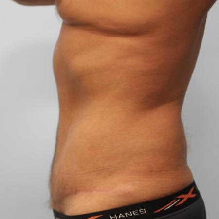 After image 3 Case #107581 - Tummy Tuck