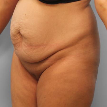 Before image 2 Case #107656 - Tummy Tuck