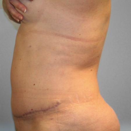 After image 3 Case #107801 - Tummy Tuck