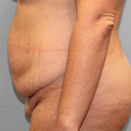 Before image 3 Case #107676 - Tummy Tuck