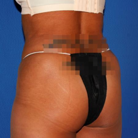 After image 4 Case #107826 - Liposuction Abdomen/Flanks with Abdominal Etching