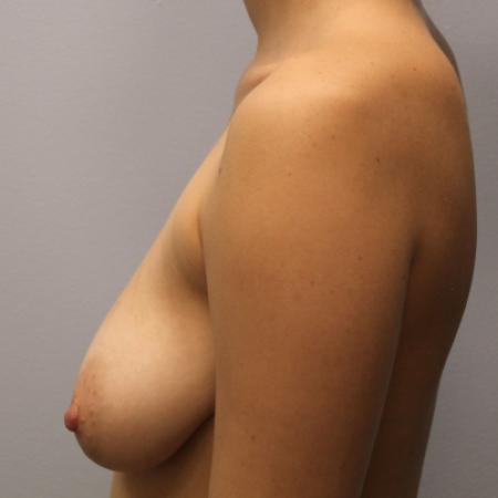 Before image 3 Case #108146 - Breast Augmentation & Lift