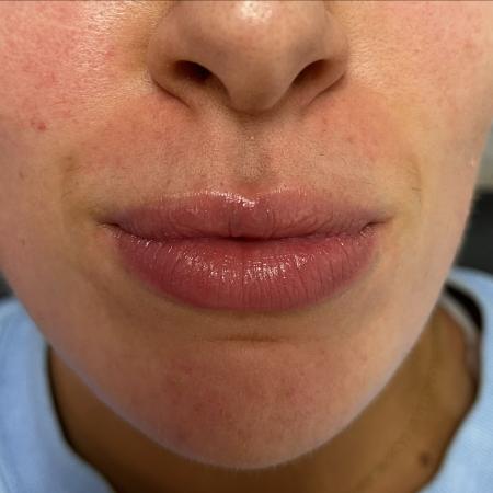 Before image 1 Case #108016 - Lip Filler