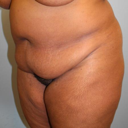 Before image 2 Case #108226 - Tummy Tuck & Lipo