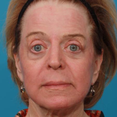 After image 1 Case #108366 - Full Face Erbium Resurfacing