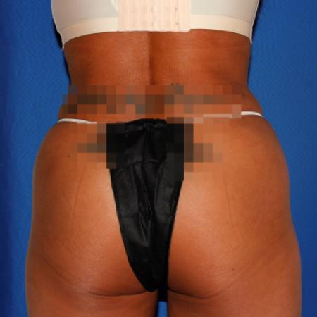 After image 5 Case #107826 - Liposuction Abdomen/Flanks with Abdominal Etching