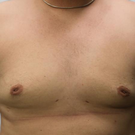 After image 1 Case #108141 - Gynecomastia