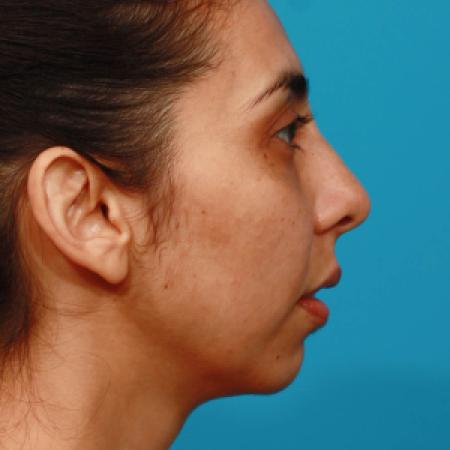 Before image 3 Case #108301 - Chin Augmentation