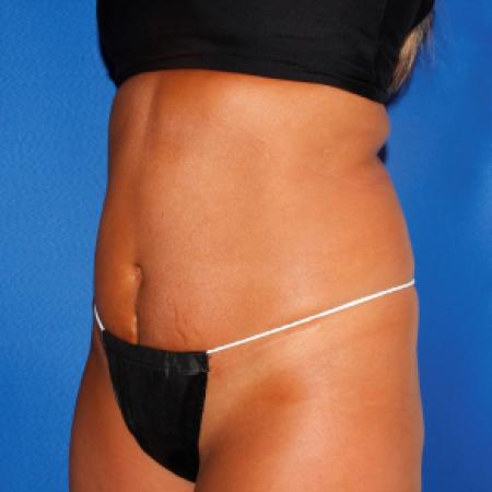Before image 2 Case #107826 - Liposuction Abdomen/Flanks with Abdominal Etching