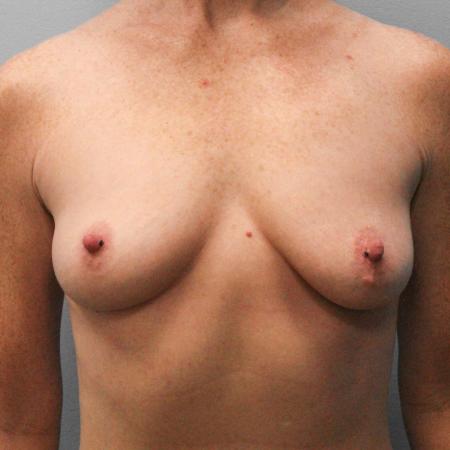 Before Case #107541 - Breast Augmentation