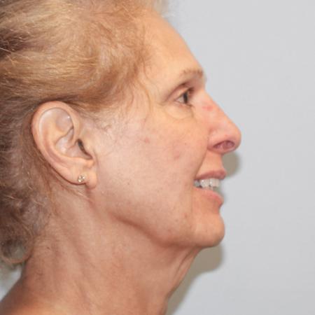 Before image 3 Case #108191 - Facelift 