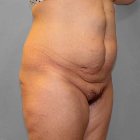 Before image 2 Case #108231 - Abdominoplasty & Lipo
