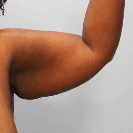 Before image 1 Case #108251 - Arm Lift & Lipo