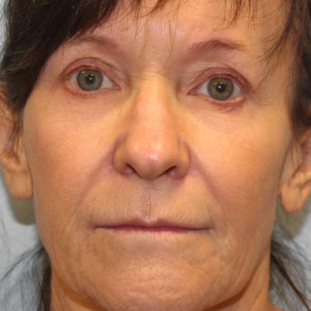 Before image 1 Case #108286 - Facelift & Blepharoplasty