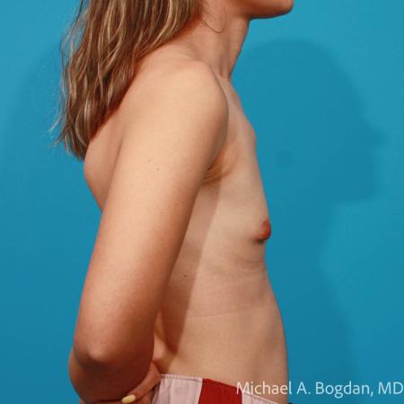 Before image 3 Case #108441 - Breast Augmentation