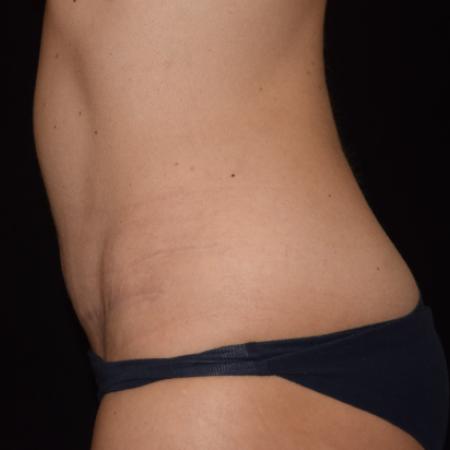 After image 2 Case #107896 - Abdominoplasty with Muscle Plication/Hernia Repair